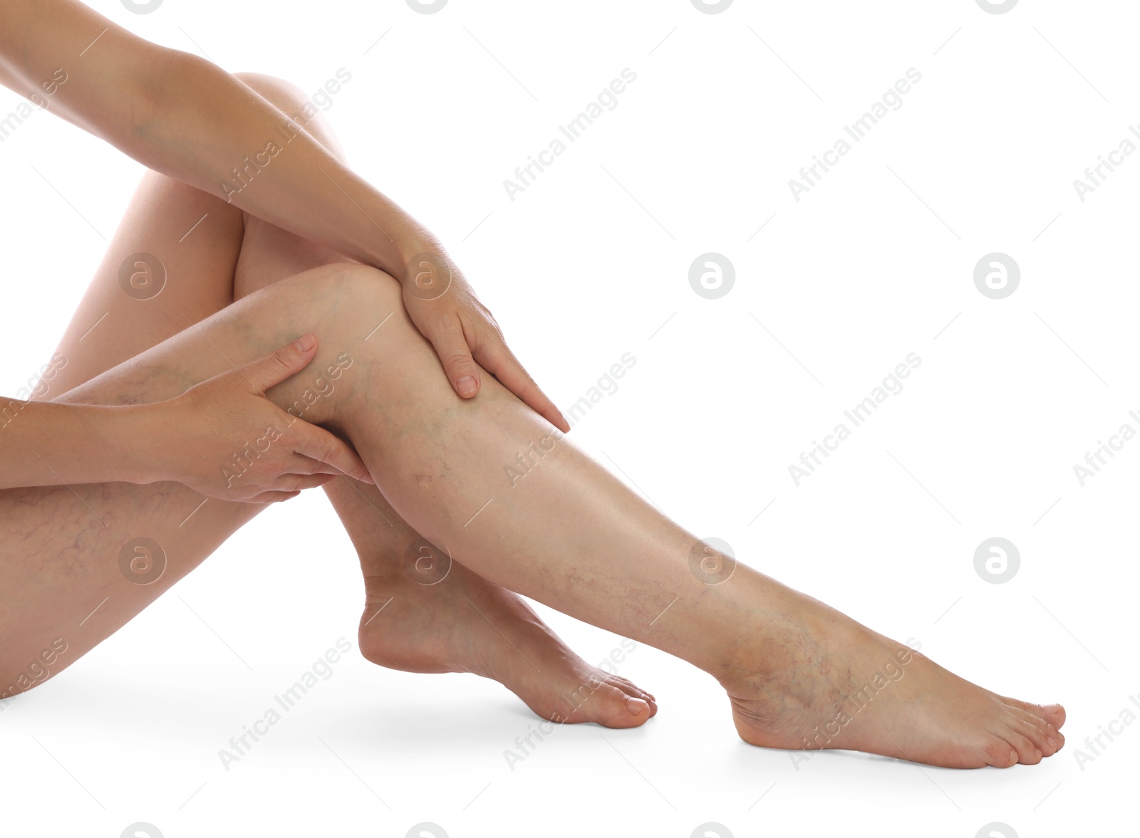 Photo of Woman suffering from varicose veins on white background, closeup