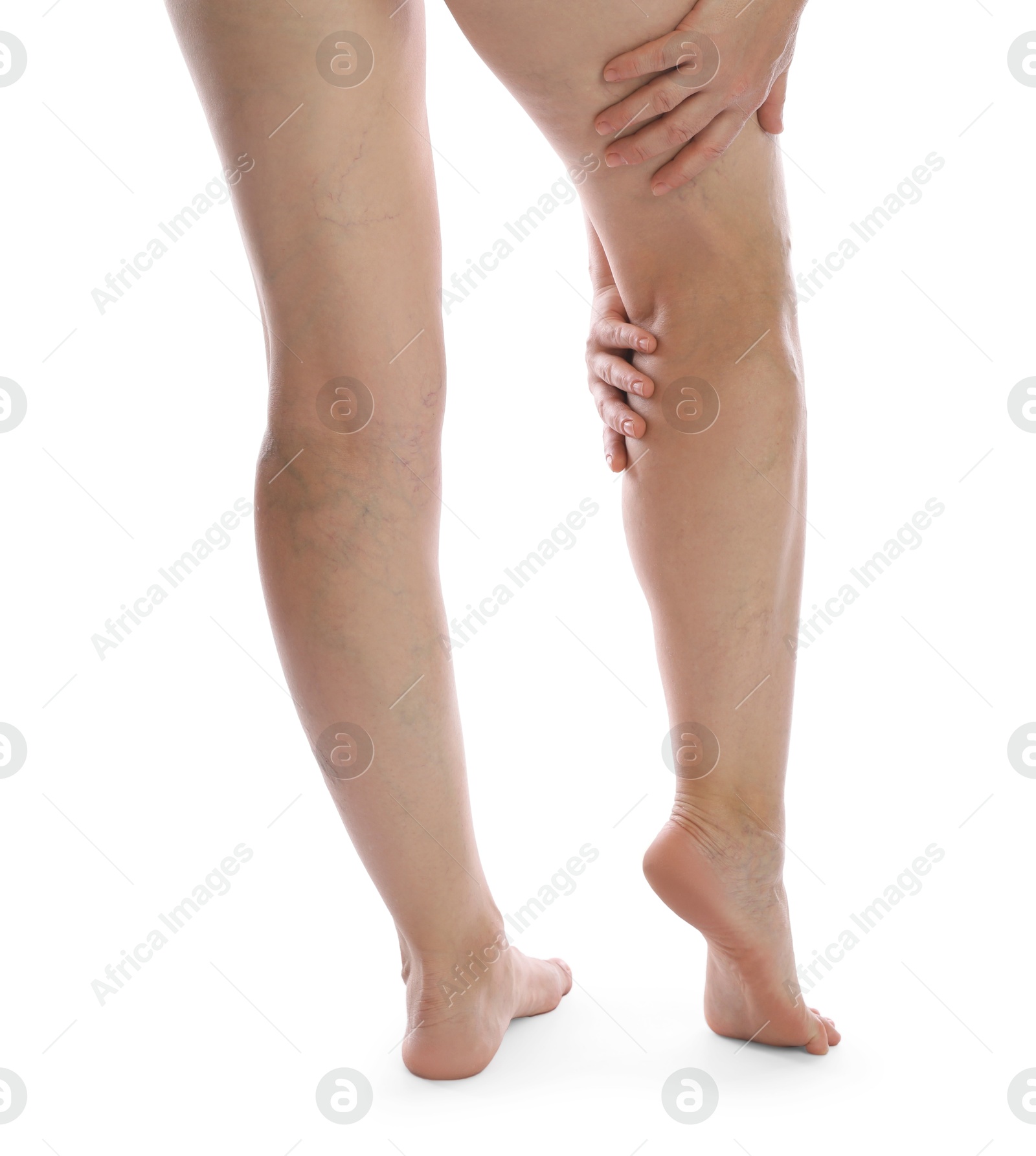 Photo of Woman suffering from varicose veins on white background, closeup