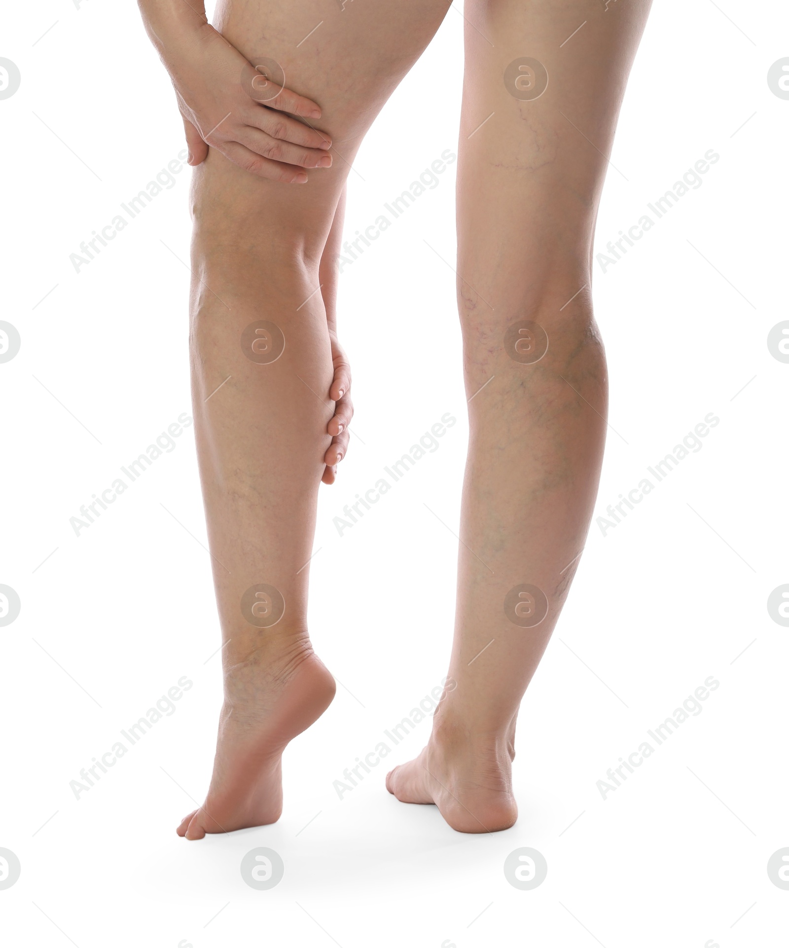 Photo of Woman suffering from varicose veins on white background, closeup