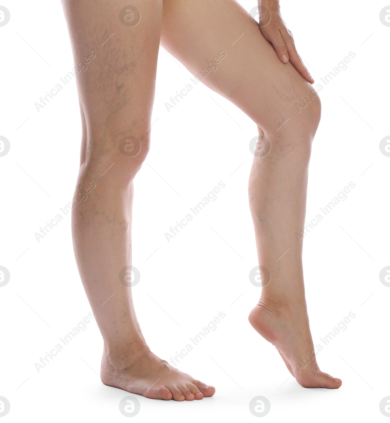 Photo of Woman suffering from varicose veins on white background, closeup