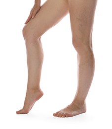 Photo of Woman suffering from varicose veins on white background, closeup