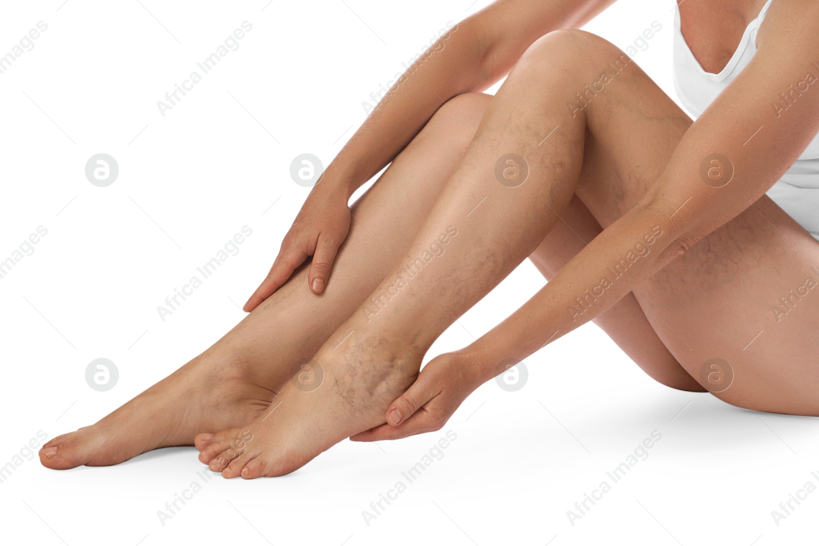 Photo of Woman suffering from varicose veins on white background, closeup