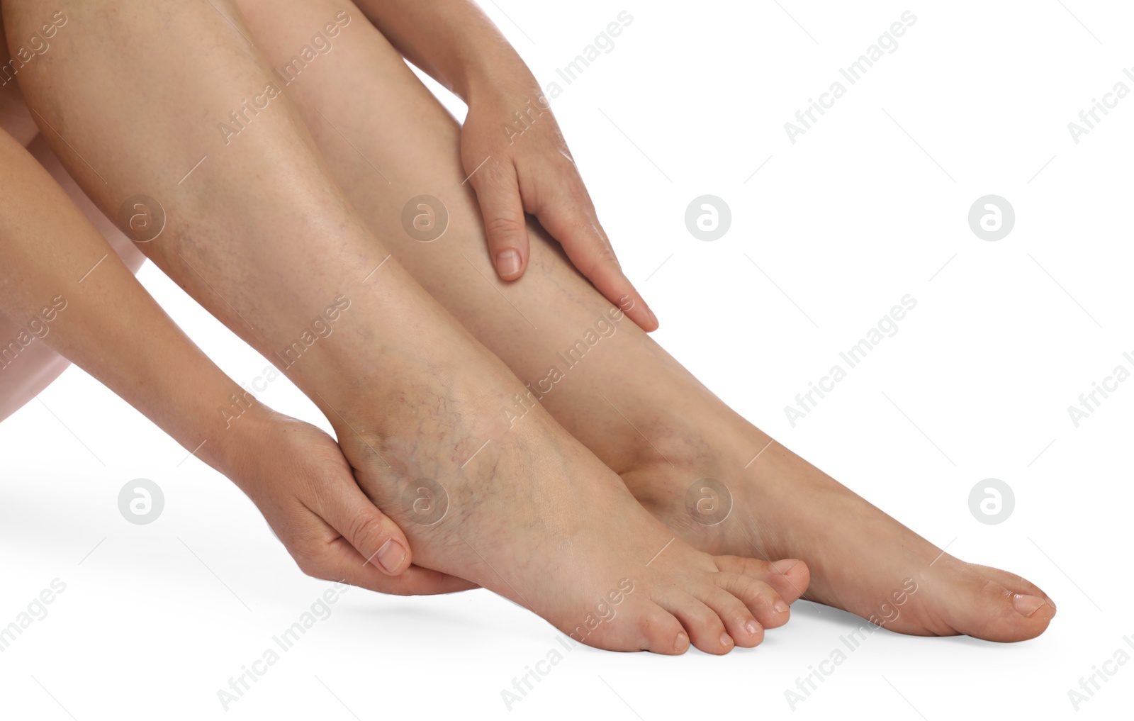 Photo of Woman suffering from varicose veins on white background, closeup