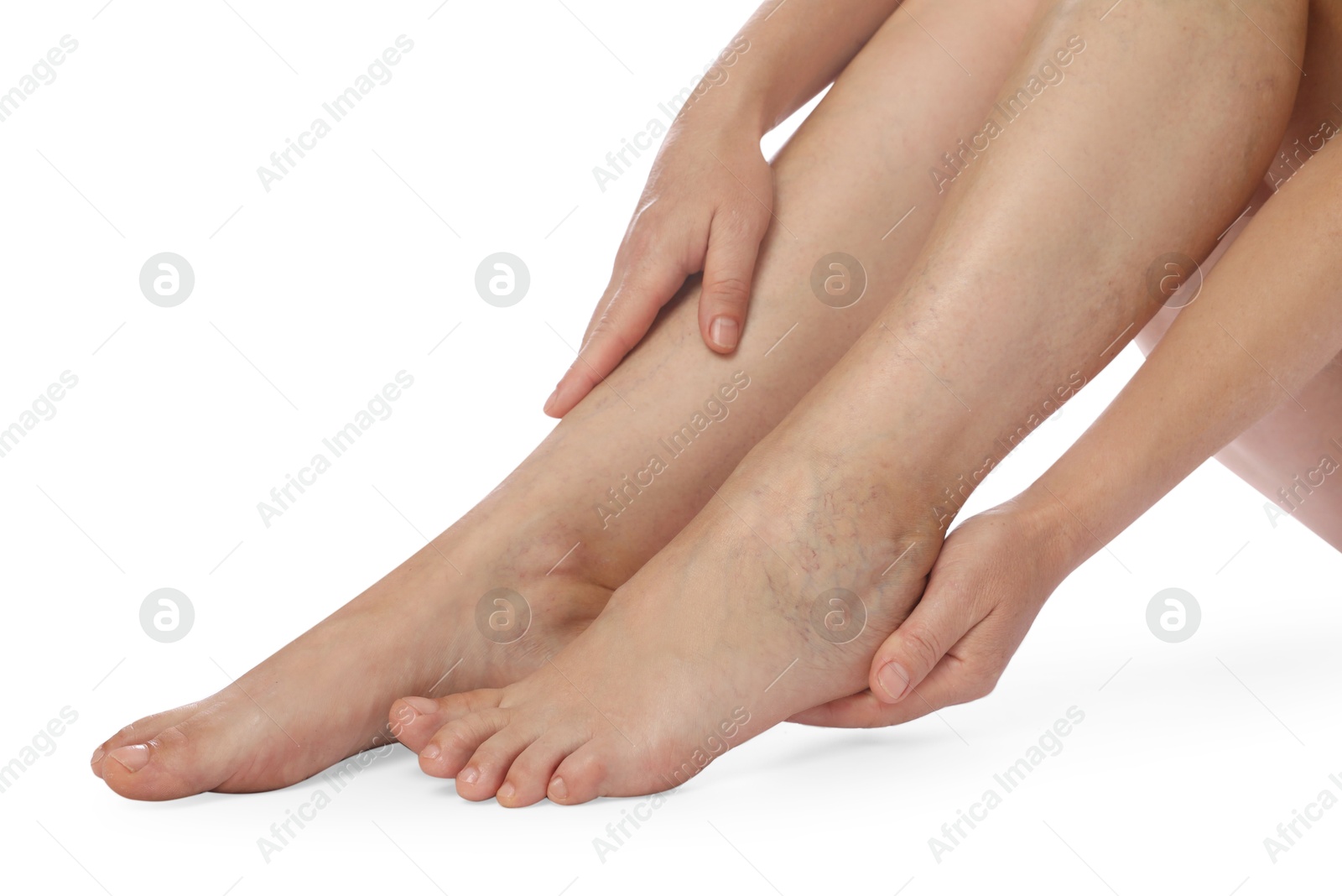 Photo of Woman suffering from varicose veins on white background, closeup