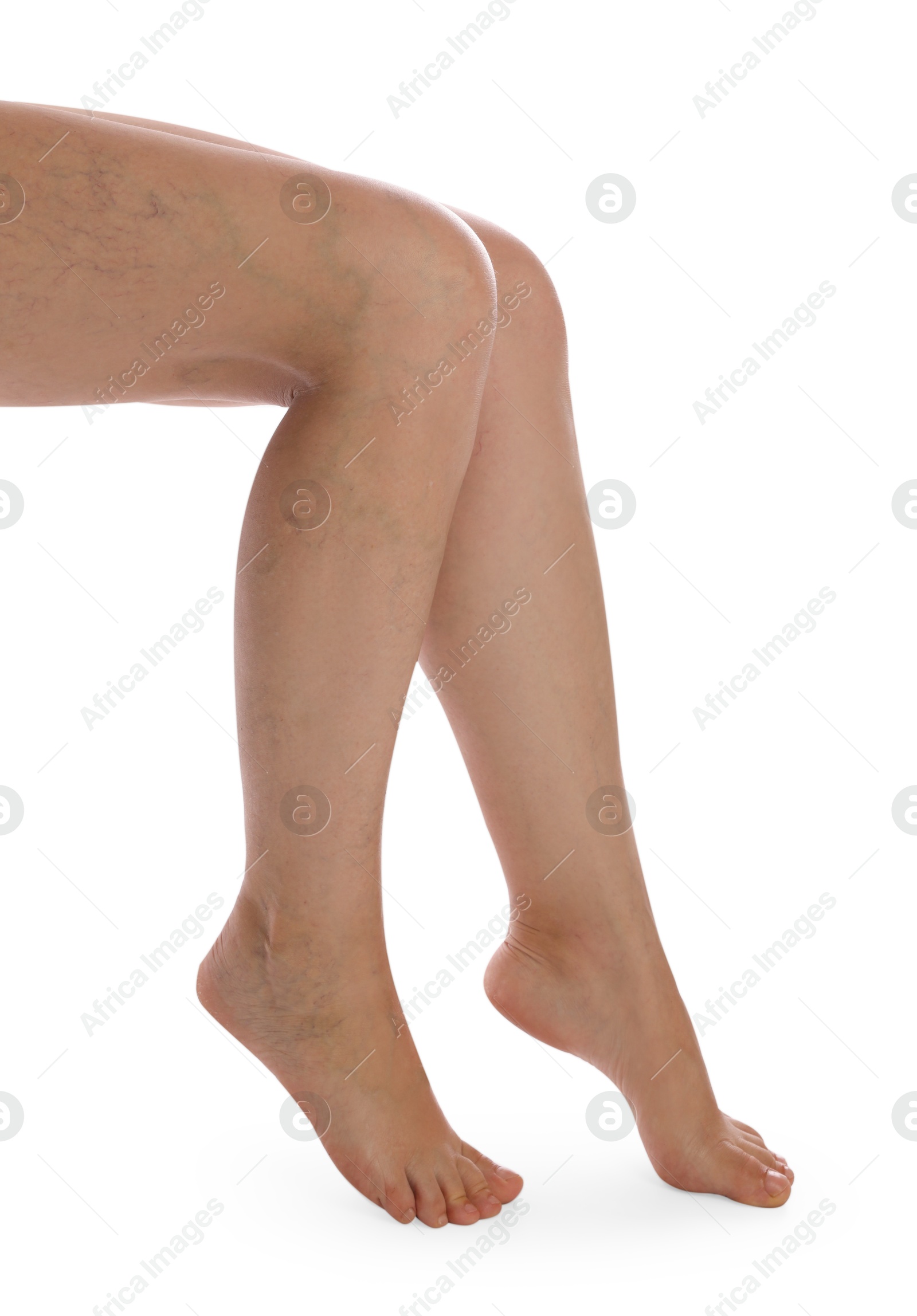 Photo of Woman with varicose veins on white background, closeup