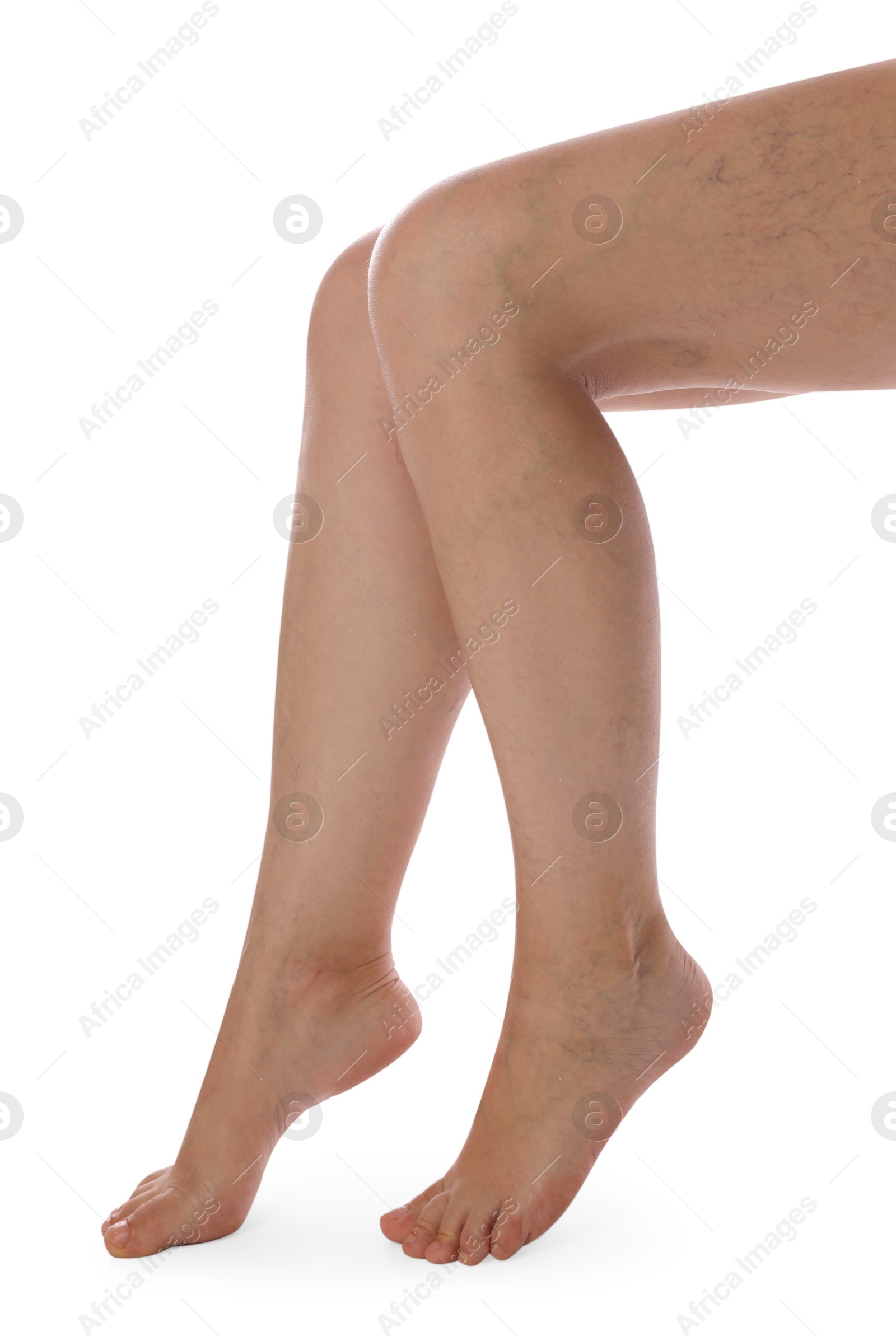 Photo of Woman with varicose veins on white background, closeup