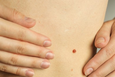 Photo of Woman with mole on her skin, closeup