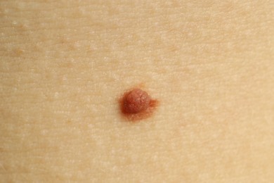 Photo of Woman with mole on her skin, closeup