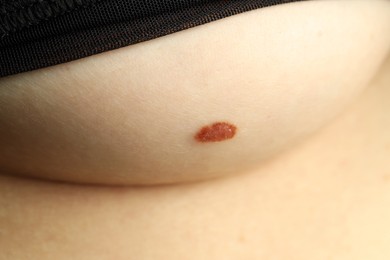 Woman with mole on her skin, closeup