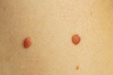 Photo of Woman with moles on her skin, closeup