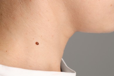 Photo of Woman with mole on her skin against grey background, closeup