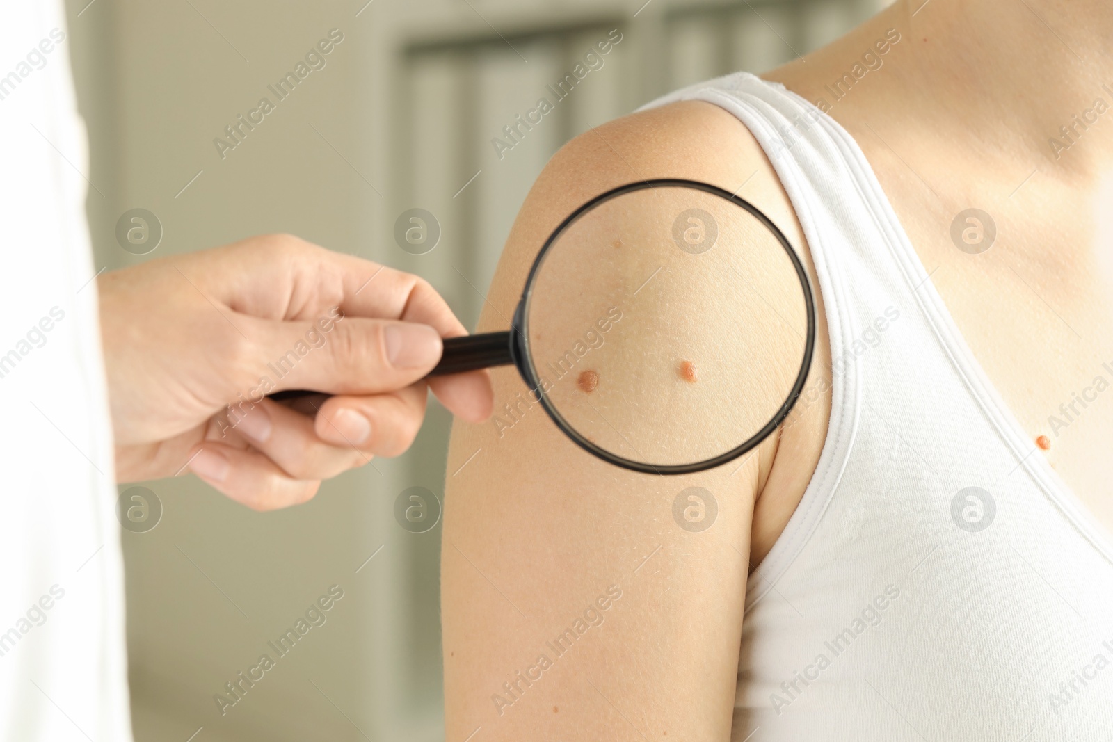 Photo of Doctor examining woman's mole with magnifying glass in clinic, closeup