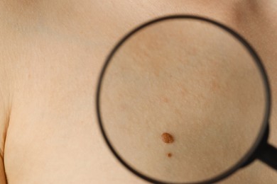 Photo of Doctor examining woman's mole with magnifying glass, closeup