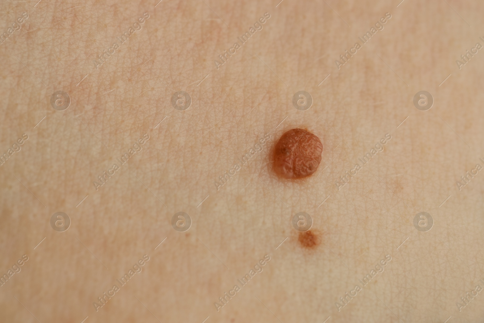 Photo of Woman with moles on her skin, closeup