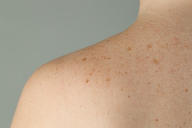 Woman with birthmarks on her skin against grey background, closeup