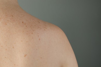 Woman with birthmarks on her skin against grey background, closeup