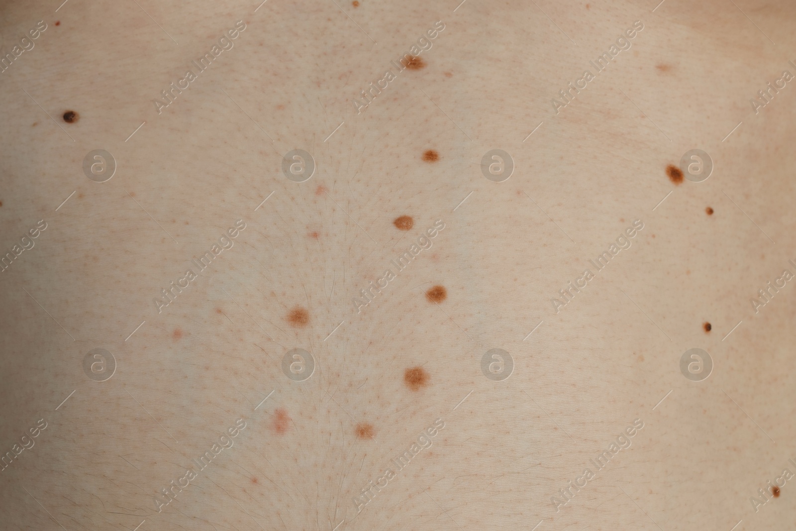 Photo of Man with birthmarks on his skin, closeup