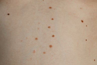 Photo of Man with birthmarks on his skin, closeup