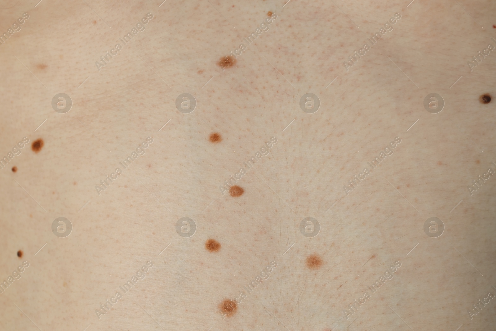 Photo of Man with birthmarks on his skin, closeup