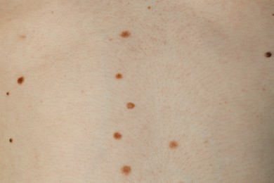 Photo of Man with birthmarks on his skin, closeup