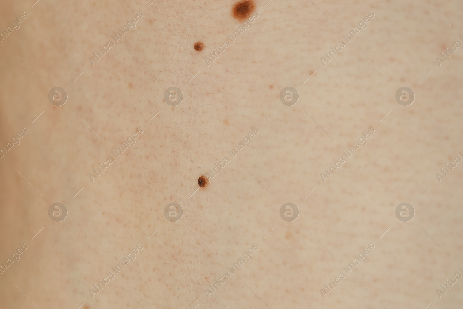 Photo of Man with birthmarks on his skin, closeup