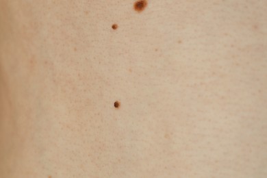 Man with birthmarks on his skin, closeup