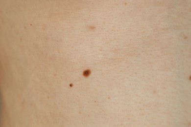 Photo of Man with birthmarks on his skin, closeup