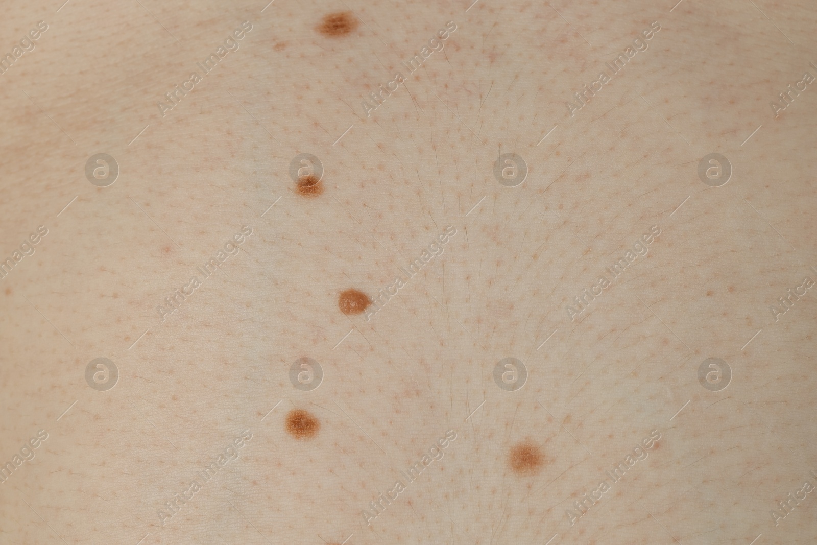 Photo of Man with birthmarks on his skin, closeup