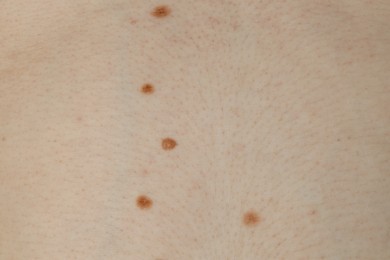 Man with birthmarks on his skin, closeup