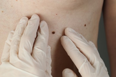 Dermatologist in gloves examining patient's birthmark, closeup