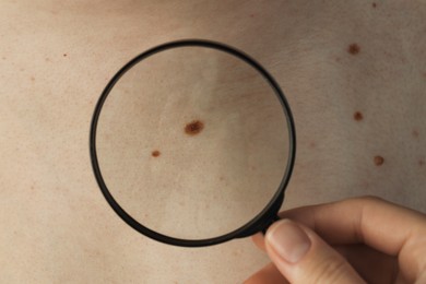 Dermatologist examining patient's birthmarks with magnifying glass, closeup