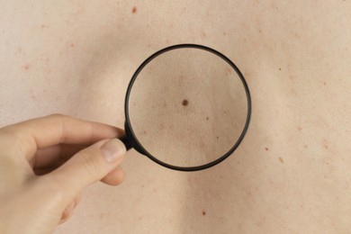 Dermatologist examining patient's birthmark with magnifying glass, closeup