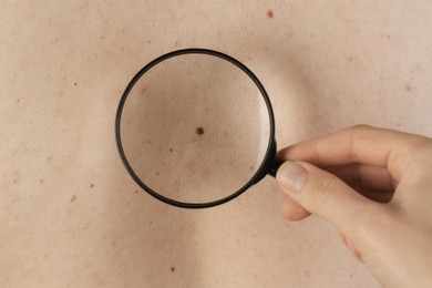 Dermatologist examining patient's birthmark with magnifying glass, closeup