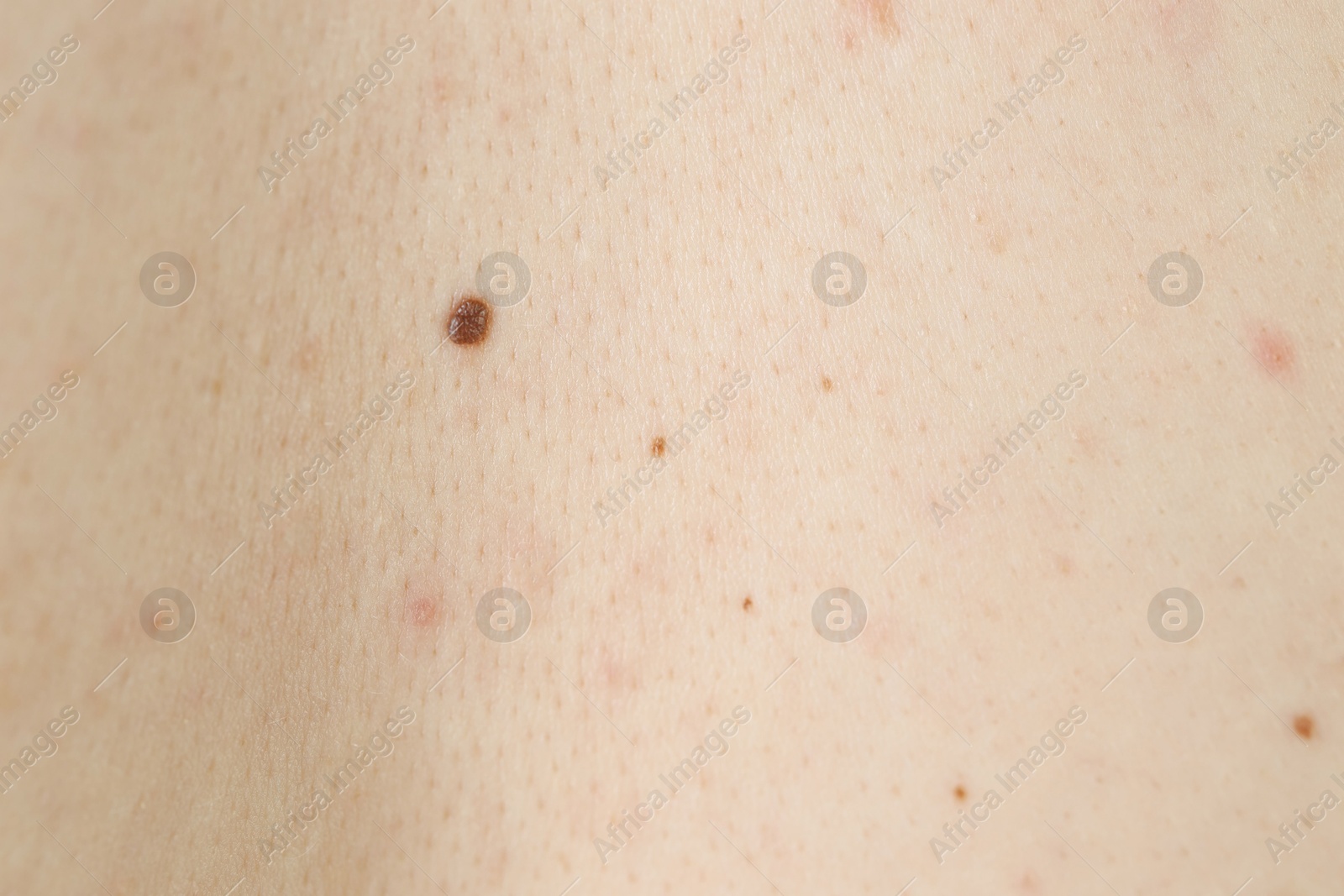 Photo of Man with birthmarks on his skin, closeup