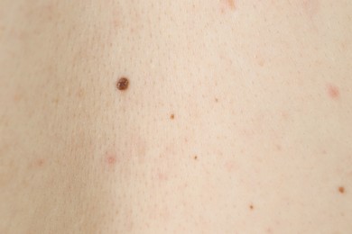 Photo of Man with birthmarks on his skin, closeup