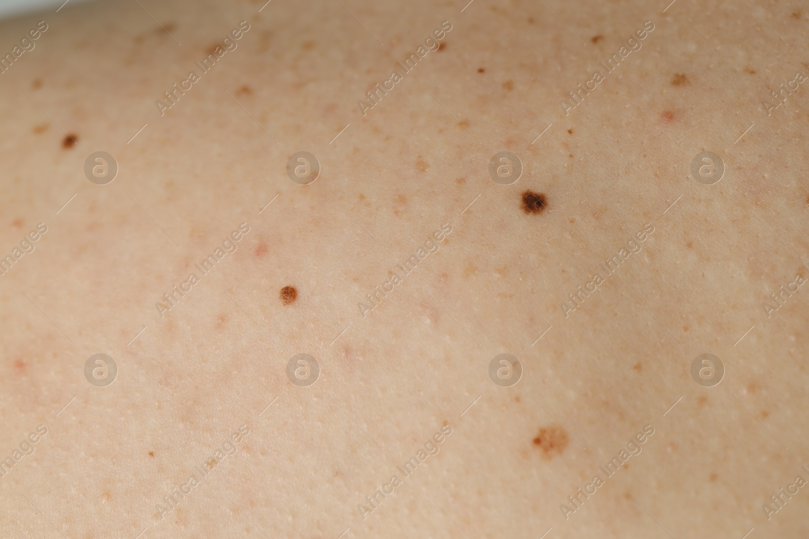 Photo of Man with birthmarks on his skin, closeup