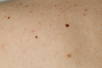 Photo of Man with birthmarks on his skin, closeup