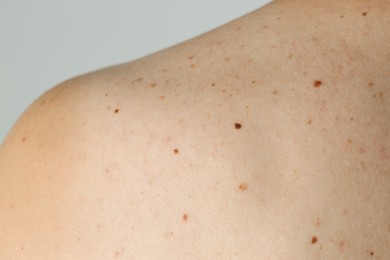 Man with birthmarks on his skin against grey background, closeup