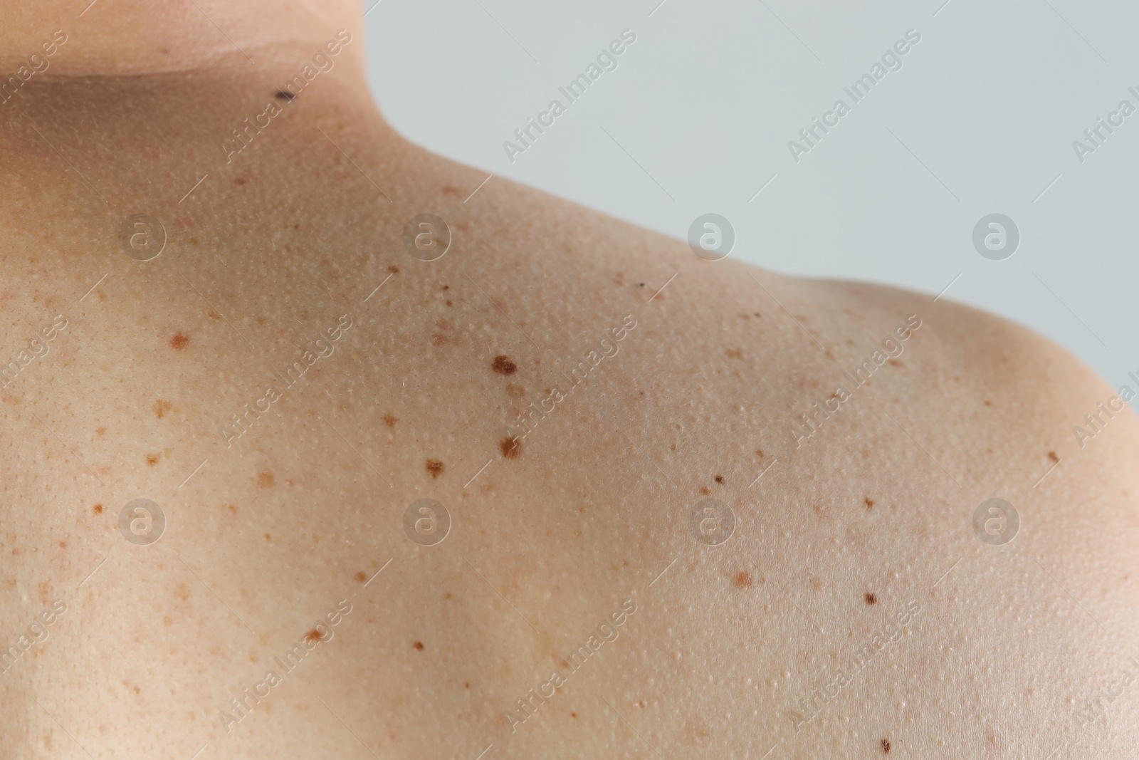 Photo of Man with birthmarks on his skin against grey background, closeup