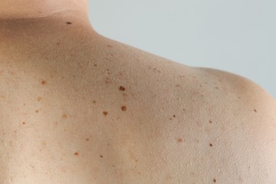 Man with birthmarks on his skin against grey background, closeup