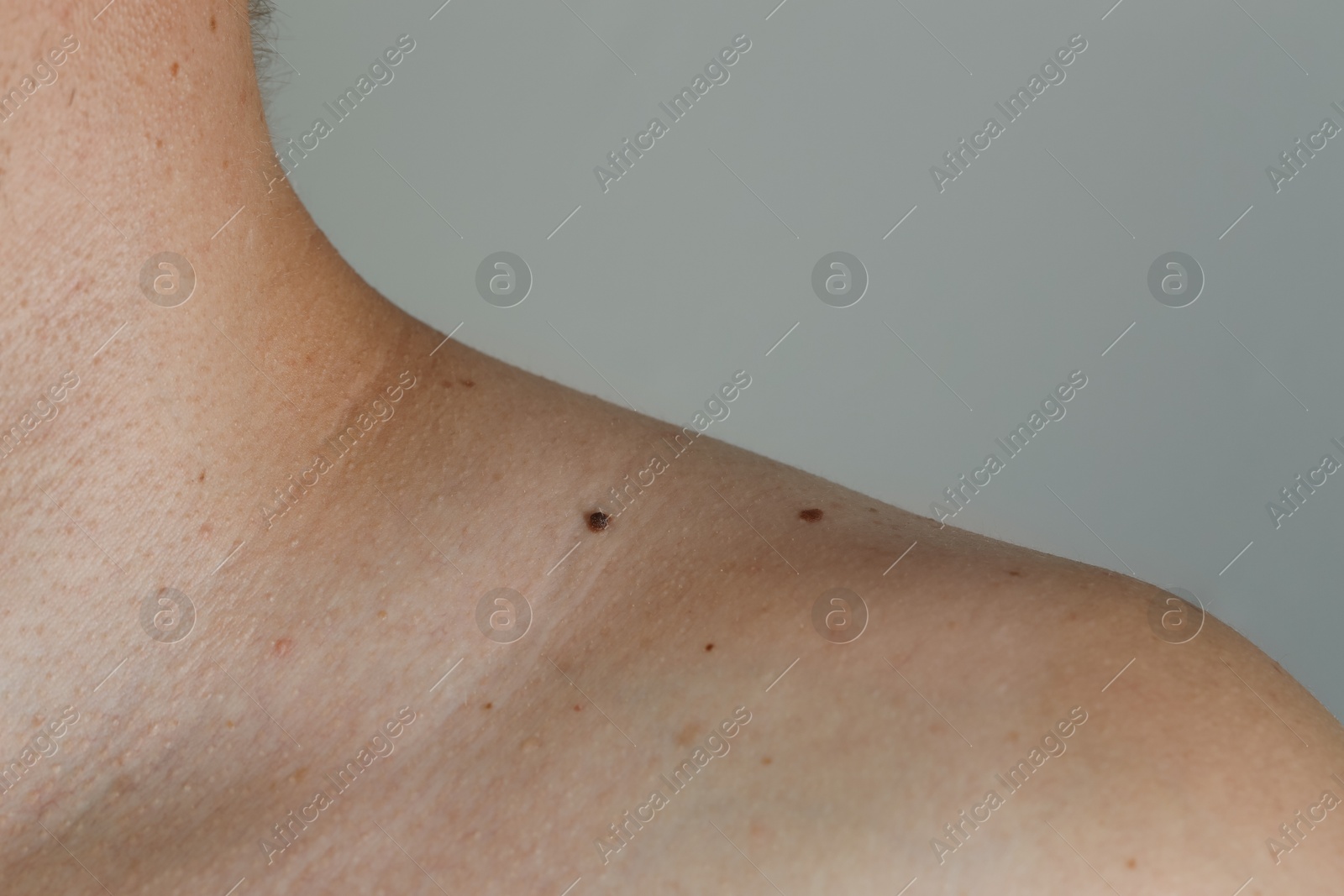 Photo of Man with birthmarks on his skin against grey background, closeup