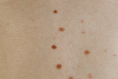 Man with birthmarks on his skin, closeup