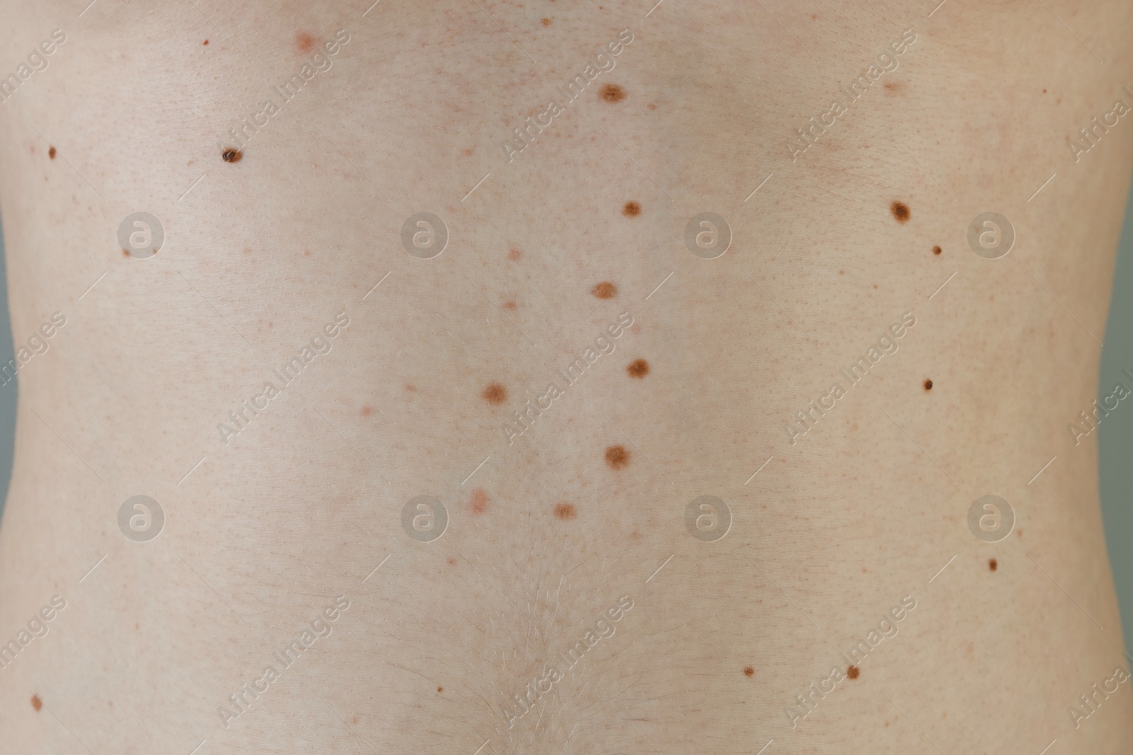 Photo of Man with birthmarks on his skin, closeup