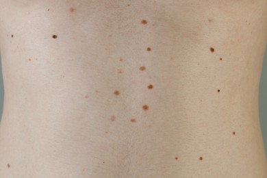 Man with birthmarks on his skin, closeup