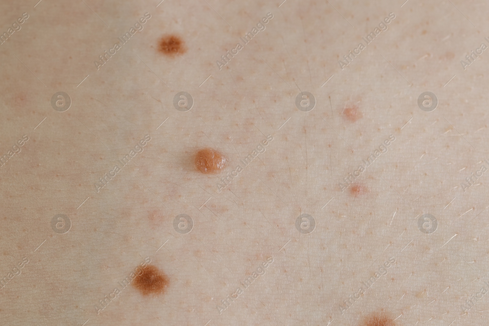 Photo of Man with birthmarks on his skin, closeup