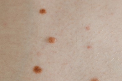 Man with birthmarks on his skin, closeup