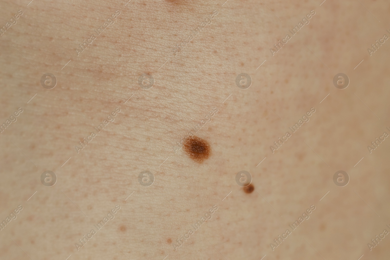 Photo of Man with birthmarks on his skin, closeup