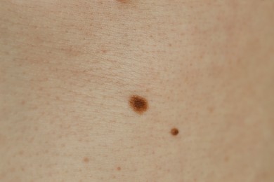 Man with birthmarks on his skin, closeup