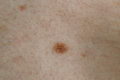 Photo of Man with birthmark on his skin, closeup