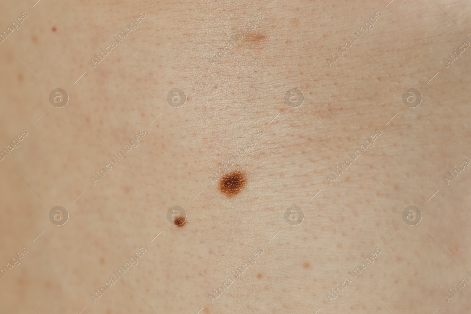 Photo of Man with birthmarks on his skin, closeup